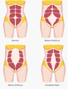 belly muscle separation shapes in women