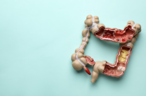bowel incontinence