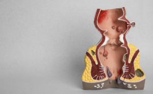  bowel incontinence