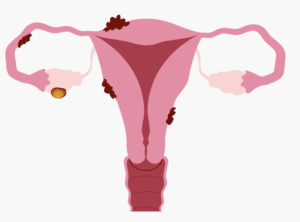 endometriosis